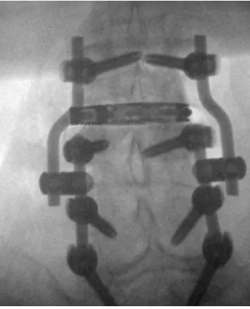 Intraoperative fluoroscopic front view of the lumbar spine showing rods, screws and connectors linking old and new implants