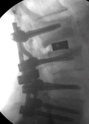 Intraoperative fluoroscopic side view of the lumbar spine showing an interbody cage and pedicle screw fixation
