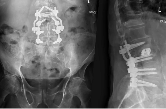 Standing front and side X-rays of the lumbar spine and pelvis after revision fusion surgery