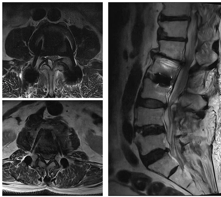 MRI of the lumbar spine before surgery, two cross-sectional views on the left and a side view on the right