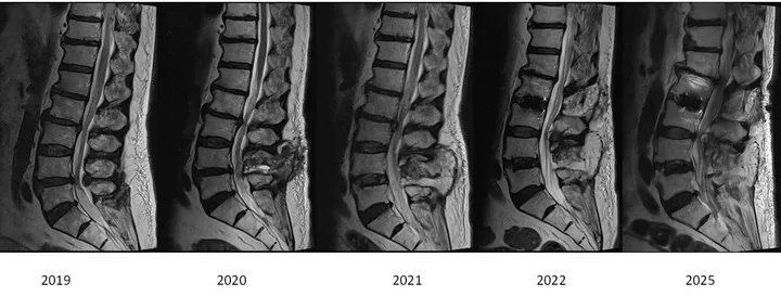 Five side-view MRI scans of the lumbar spine placed side by side and labelled 2019, 2020, 2021, 2022 and 2025