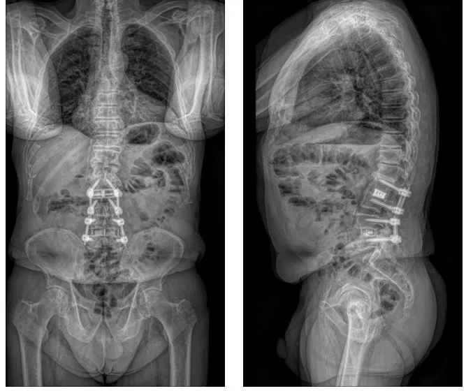 Standing front and side X-rays of the trunk before surgery showing two separate sets of screws and rods in the lumbar spine