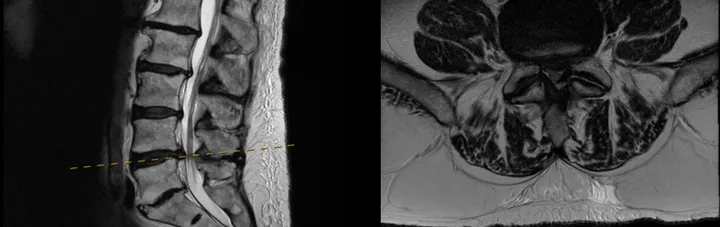 MRI of the lumbar spine before surgery, a side view on the left and a cross-sectional view at L4/5 on the right