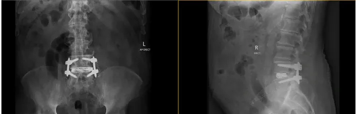 Standing front and side X-rays of the lumbar spine after surgery showing an interbody cage at L4/5 with pedicle screws and rods