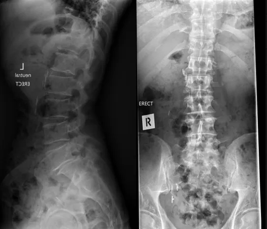 Standing side and front X-rays of the lumbar spine before surgery showing degenerative change at the lower levels